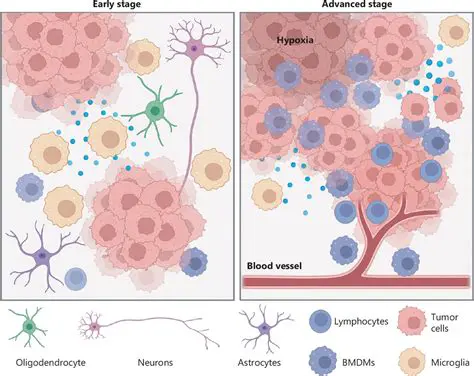 The Challenge of Distinguishing Between Glioblastoma and Metastasis Tumors