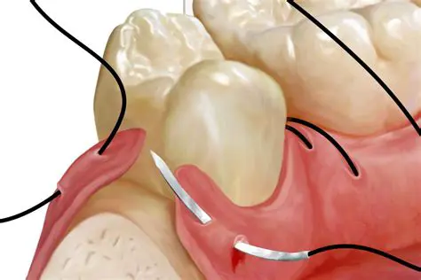 The Importance of Suturing Techniques in Odontectomy Surgery